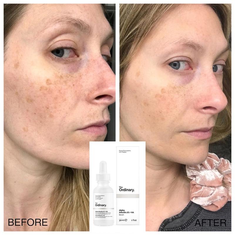 The Ordinary Alpha Arbutin 2% + HA, 30ml - Image 2